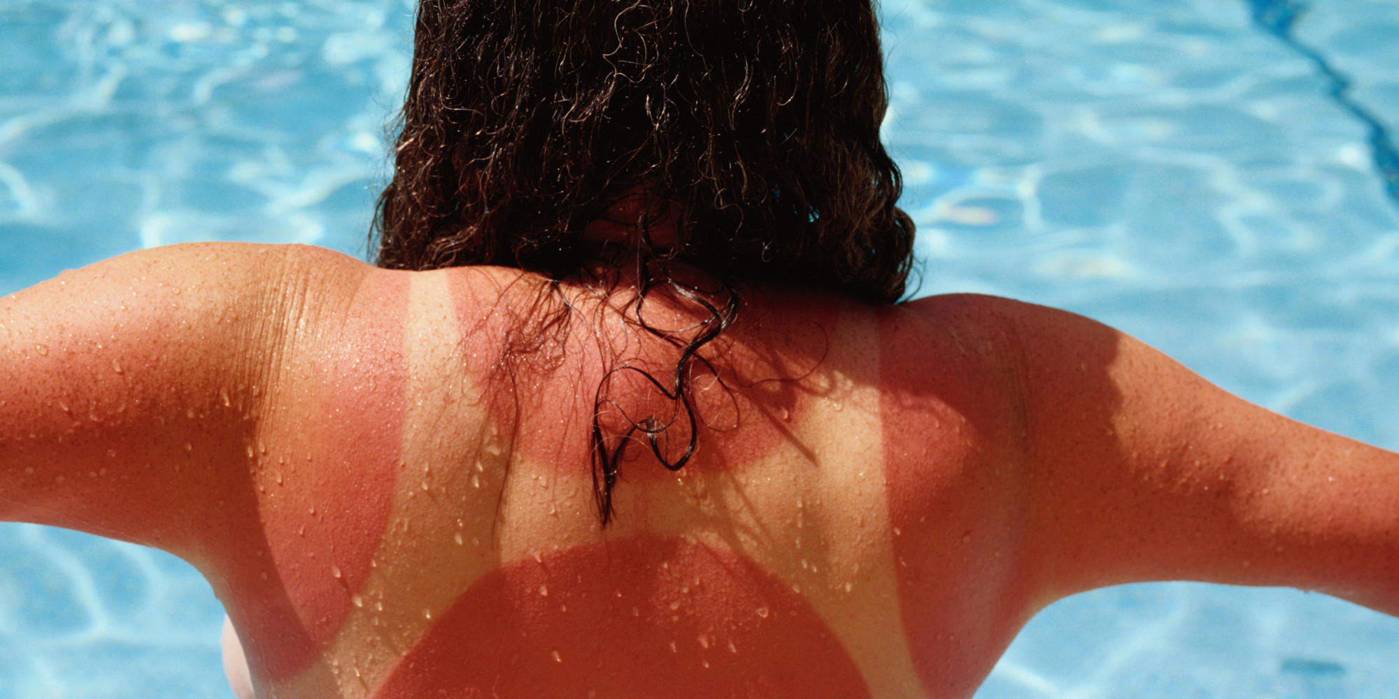 Cornstarch-and-water-to-treat-sunburn