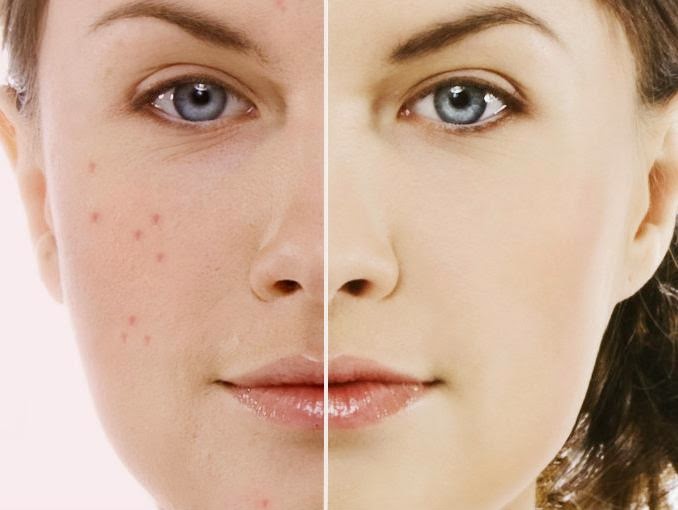 cystic-acne-causes-and-treatments
