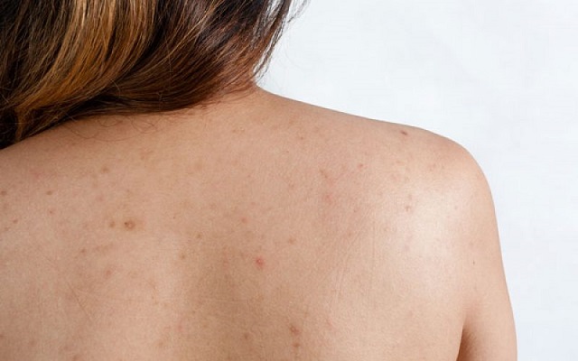 cystic-acne-on-back