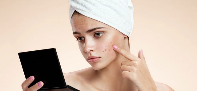 pustules-acne-causes-treatments