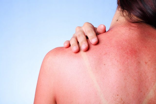 How long does sunburn hurt