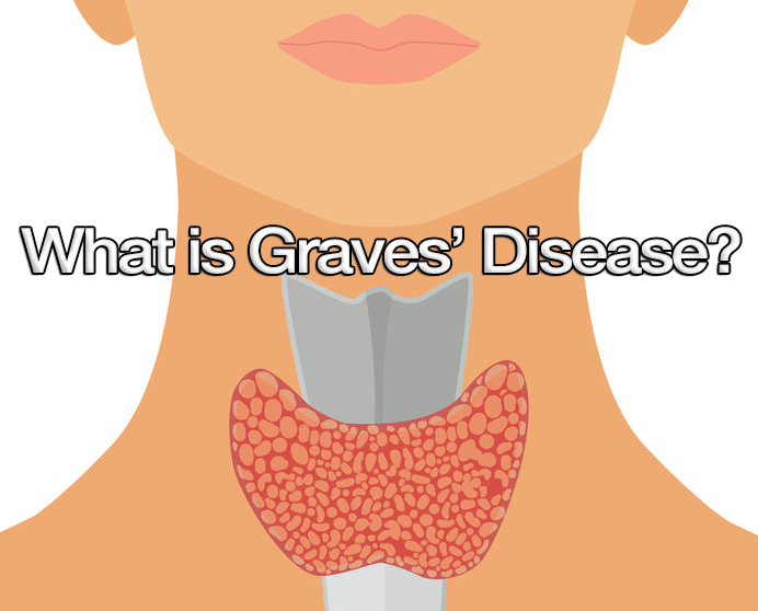 Graves disease